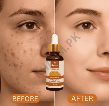 Before and after comparison of a face with acne treatment, featuring a bottle labeled 'Relax'.
